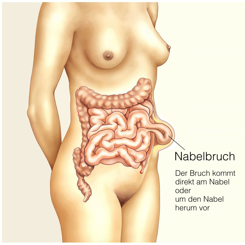 Hernienchirugie - Wie sieht ein Nabelbruch aus?