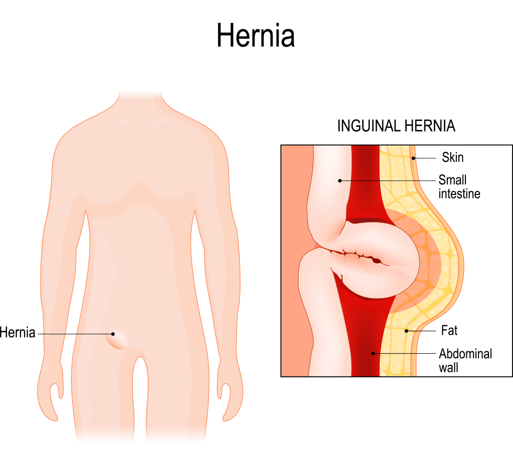 Hernienchirugie, Hernienoperation Wien