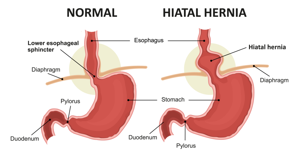 Hernienchirugie - Anatomie der Bauchwand