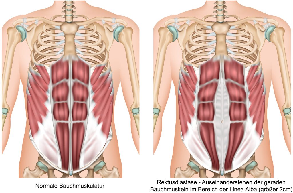 Rektusdiastase Anatomie Bauchmuskeln, Vergleich der Bauchwand bei normalem Bauch und Bauch mit Rektusdiastase