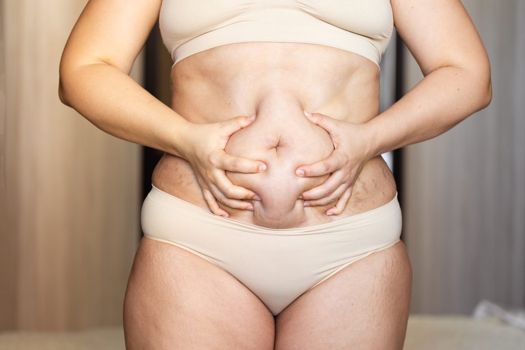 Cropped übergewichtige fette Frau hält Bauch überschüssige Flabs. Schnelle Gewichtsabnahme, zeigt Cellulite. Fettleibigkeit Magen, Cellulite